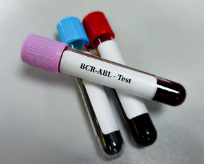 BCR-ABL test looks for diagnose and monitor the treatment of chronic myeloid leukaemia (CML).BCR-ABL RNA Quantification test.