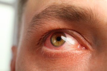 Fototapeta premium Closeup view of man with inflamed eyes