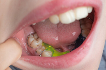 Mandibular plate, a boy wears a plate to align his teeth. © Niko_Dali