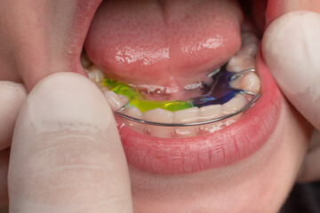 The orthodontist puts a plate on the lower teeth, a visit to the orthodontist. © Niko_Dali