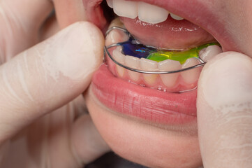 The orthodontist puts a plate on the lower teeth, a visit to the orthodontist. © Niko_Dali