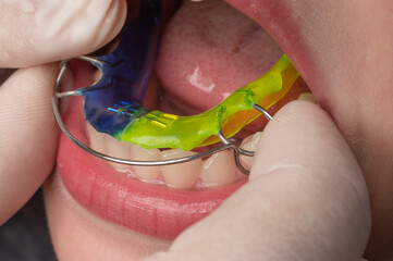 Plate for the lower teeth, orthodontic and plate for the teeth of the lower jaw. © Niko_Dali