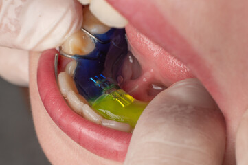 Plate for the lower teeth, orthodontic and plate for the teeth of the lower jaw. © Niko_Dali