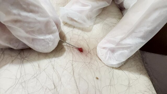 Detail of female hand removing ingrown hair on leg with insulin needle