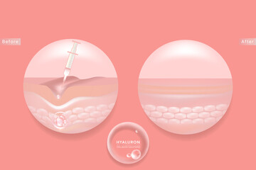 Hyaluronic acid before and after skin solutions ad, pink collagen serum injection, cosmetic advertising background ready to use, illustration vector.	
