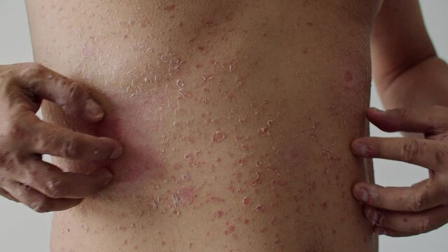 Psoriasis is the abdomen on white background. 4K Slow Motion VDO