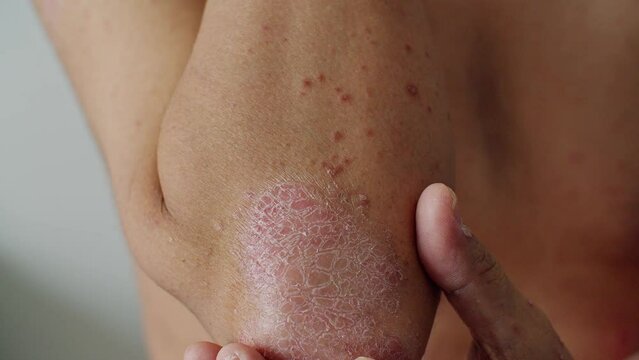 Psoriasis is that elbow on white background. 4K Slow Motion VDO