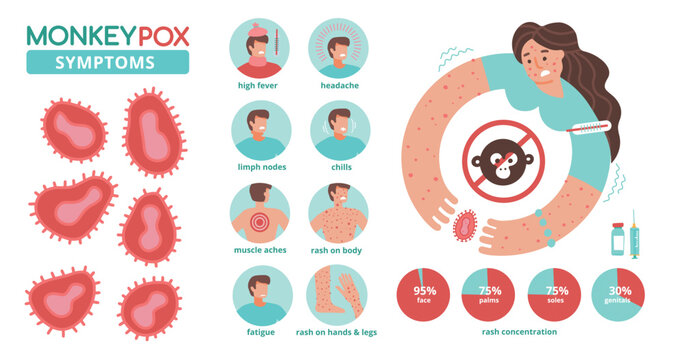 Monkeypox virus symptoms infographics. New orthopox virus outbreak worldwide spreading. Detailed info for people awareness in human diseases infection. Medical concept. Flat vector illustration.