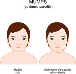 Mumps. Epidemic parotitis. viral disease