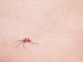 Non-absorbable suture on the skin, copy space. Little and careful stitches to close the wound