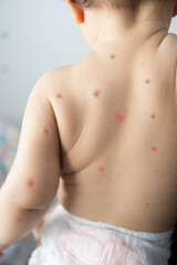 Fototapeta na wymiar Monkey pox new disease. Baby with monkey pox. Painful rash, blisters of red spots on hand.