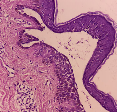 Microscopic image of back skin tissue, Pemphigus vulgaris, smear show suprabasal acantholysis. Intraepidermal vesicles with round acantholytic keratinocytes.