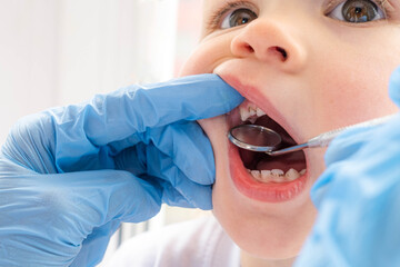 Closeup open mouth child and mirror in dentists hands in blue gloves checkup examine treating teeth to child, health care, children dental hygiene
