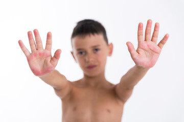 child shows his hands with dermatitis and eczema