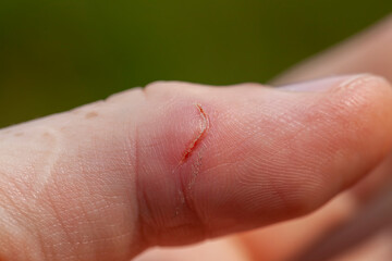 A cut thumb on the hand, close up