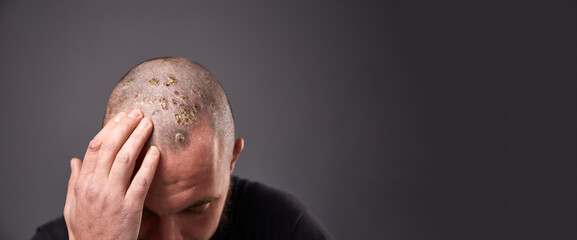 Man with dry flaky skin on his head with psoriasis and nail fungus on hands. Autoimmune genetic disease. © leravalera89