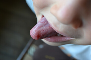 Child's bitten tongue. Close-up of lips, tongue, protrusion of blood