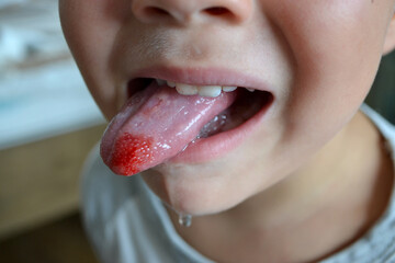 Child's bitten tongue