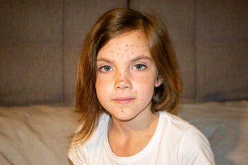 Varicella virus or Chickenpox bubble rash on child