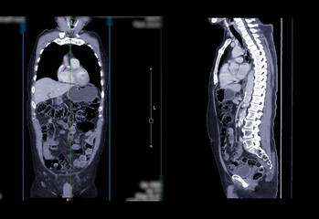 CT SCAN of Chest and Abdomen Coronal and sagittal view.