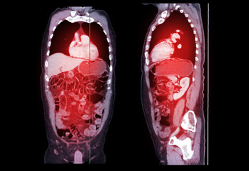 CT SCAN of Chest and Abdomen Coronal and sagittal view.