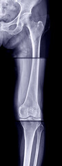 Film x-ray of Hip joint , femur bone and knee joint fusion from 3 image.