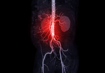 CTA of the abdominal aorta . - obrazy, fototapety, plakaty