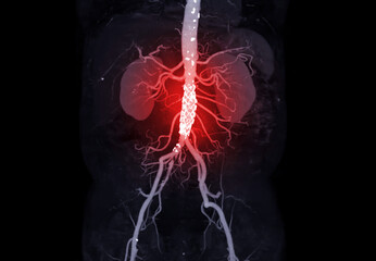 CTA of the abdominal aorta .