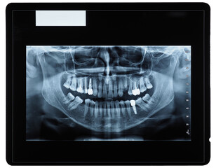orthopantomograph panoramic image radiograph of teeth transparen © Claudio Divizia
