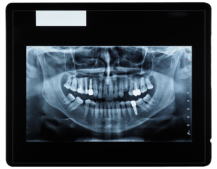 orthopantomograph panoramic image radiograph of teeth transparen