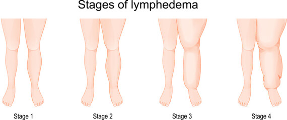lymphedema stages.