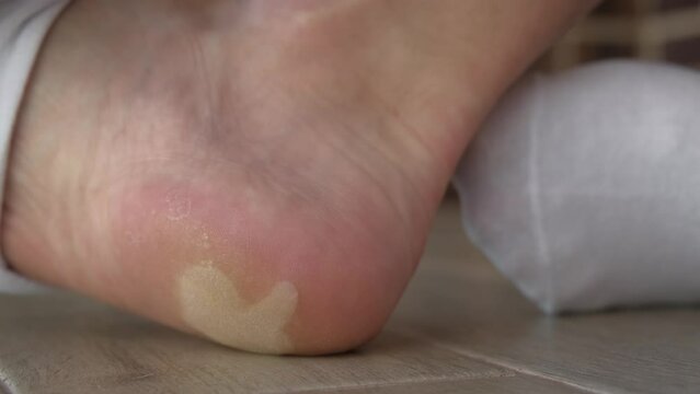 A man shows a large dry callus on his heel, close-up
