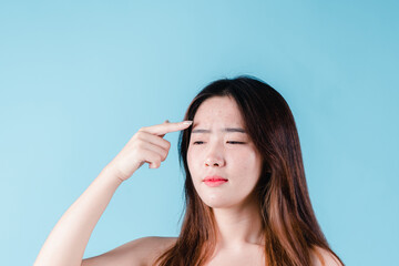 Fototapeta premium Asian woman having skin problems acne, spot her squeezing pimples on her face on the blue background.