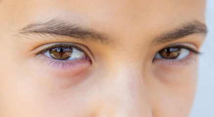 The child eye is inflamed. Selective focus.