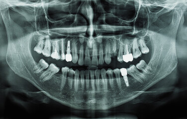 orthopantomograph panoramic image radiograph of teeth