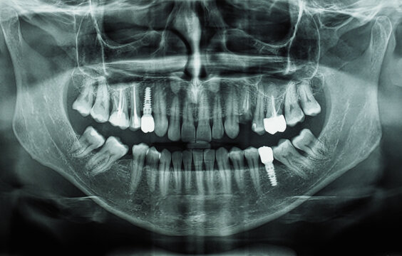 Orthopantomograph Panoramic Image Radiograph Of Teeth