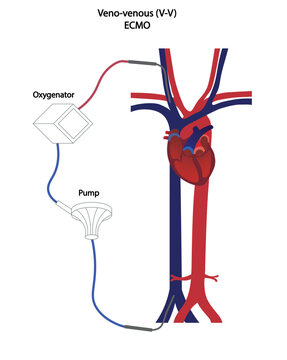 Veno-venous ECMO illustration. Blood flow illustration os a V-V ECMO