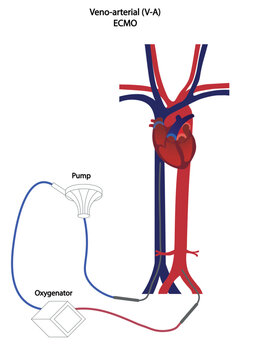 Veno-arterial ECMO illustration. Blood flow illustration os a V-A ECMO
