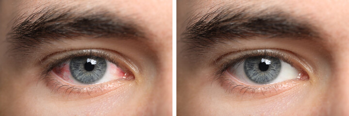 Collage with photos of man with inflamed and healthy eyes before and after treatment, closeup. Banner design