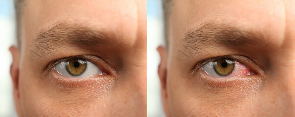 Collage with photos of man with inflamed and healthy eyes before and after treatment, closeup....