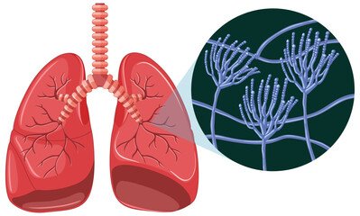 The mold spores grow in human lungs