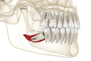 Mesial impaction of Wisdom tooth and bone inflammation. Medically accurate tooth 3D illustration