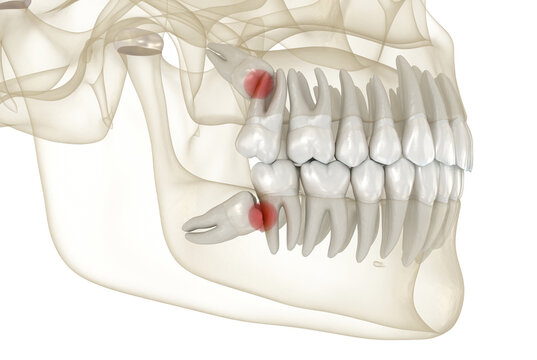 Mesial impaction of Wisdom teeth to the second molar. Medically accurate tooth 3D illustration