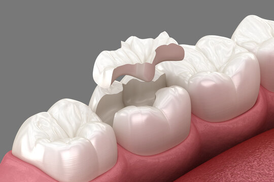 Inlay ceramic crown placement. Medically accurate 3D illustration of human teeth treatment
