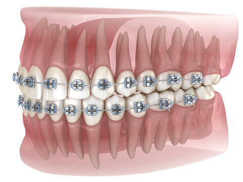 Metal braces and transparent dental model. Medically accurate 3D illustration