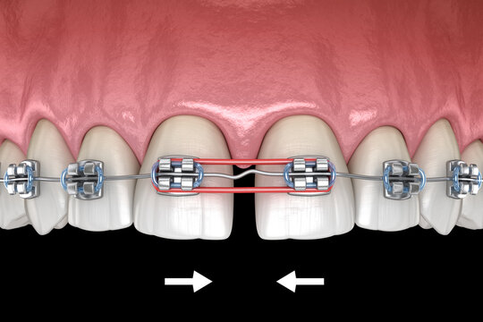 Elastics and metal braces for diastema correction. Medically accurate dental 3D illustration