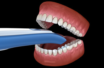 Intraoral Teeth 3D scanner. My own design. Dental 3D illustration concept