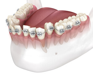 Abnormal teeth position and correction with metal braces tretament. Medically accurate dental 3D illustration