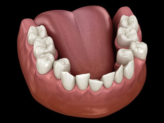 Overcrowded teeth, abnormal dental occlusion. Medically accurate tooth 3D illustration - obrazy, fototapety, plakaty