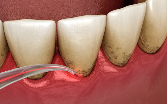 Dental laser remove tartar and thin layer of infected skin. Dental 3D illustration